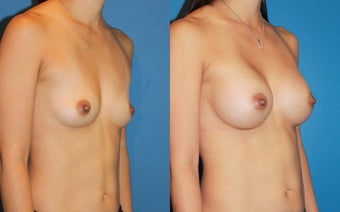 Breast Augmentation after 310716