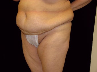Abdominoplasty before 258236