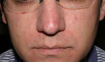 Vein treatment after 135906