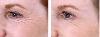Botox Cosmetic after 253623