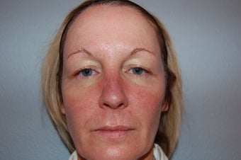 IPL Limelight Laser treatment, Pearl Laser Treatment and Botox before 429560