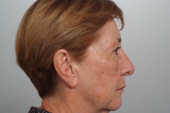 Laser resurfacing for dyschromia (brown spots) before 253091