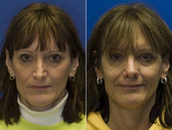 Revision Rhinoplasty before 295349