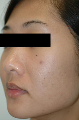 Laser Acne Scar Removal after 82972