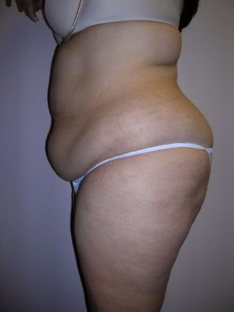 Liposuction before 258663