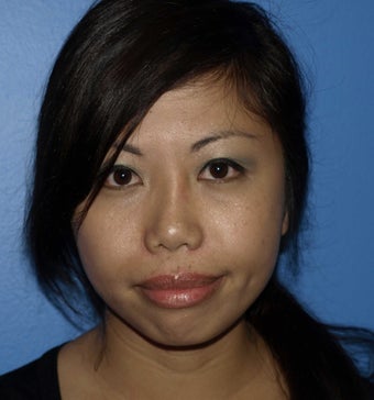 Revision Rhinoplasty with Chin Implant before 283303