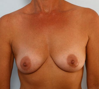 Breast Augmentation before 260907