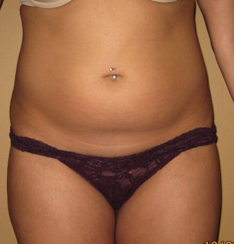 liposuction before 269322
