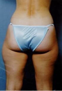 Suction Lipectormy of Inner and Outer thighs 427988