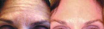 Botox & Dysport before 354055