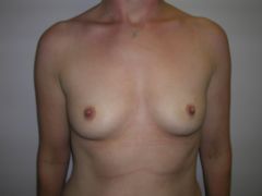 Breast Augmentation before 258490