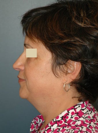 Facelift before 137056