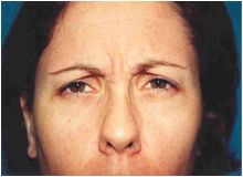 Chemical Brow Lift before 568456