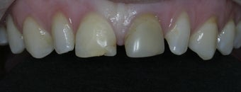 Porcelain Veneers and Crowns before 485383