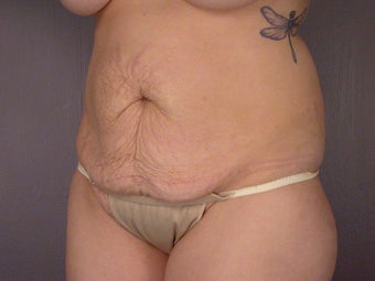 Tummy Tuck before 338735