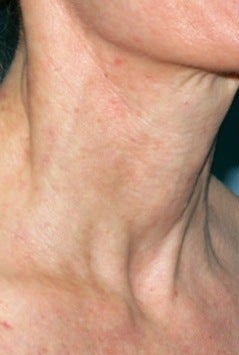 Vbeam laser treatment 374531