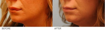 Lip Reduction after 245416