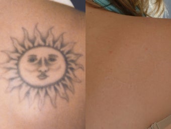 Laser Tattoo Removal before 356514