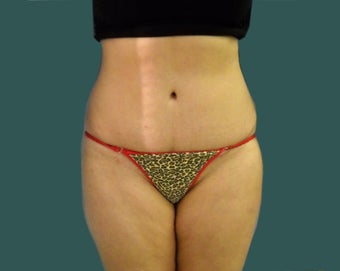 Tummy tuck after 561249