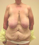 Breast Reduction Surgery and Tummy Tuck 152005
