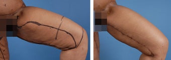 Thighplasty before 303693