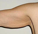 Arm Lift (Brachioplasty) before 142518