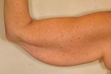 Brachioplasty (Arm Lift) before 293439