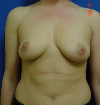Breast Augmentation before 347972