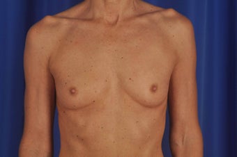 50 year-old woman desired breast implants before 634069