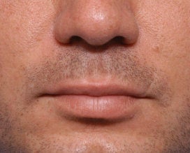 Lip Lift before 521702