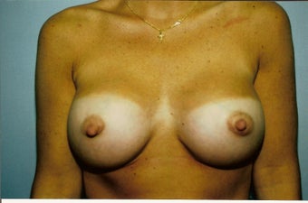 Breast augmentation after 237292