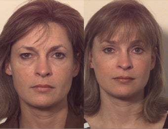 Composite facelift before 102532