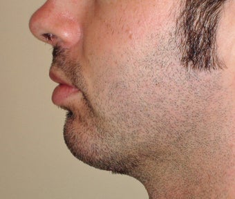 Chin Augmentation after 365432