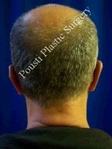 Ear Surgery (Otoplasty) after 584571