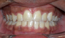 Braces and Extraction after 349089
