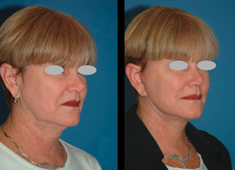 Neck lift and Mini-facelift before 306839