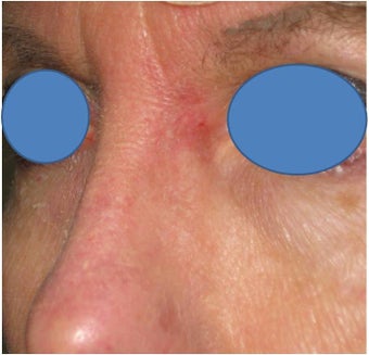 Repair of Mohs surgery defect on the left nose after 83242