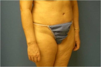 Abdominoplasty, Tummy Tuck, Liposuction 401748