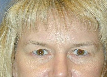 Blepharoplasty before 142232
