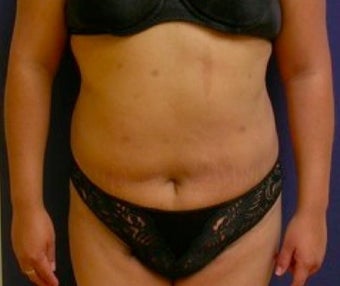 Liposculpture for stomach after 374835