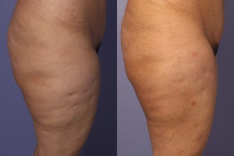 Cellulaze before 607920