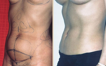 Abdominoplasty before 270031