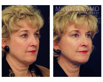 Facial Rejuvenation - Neck Lift after 395191