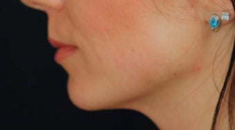 Lip Augmentation after 399231