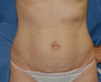 Mini-abdominoplasty before 493674