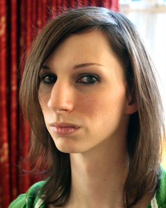 Rhinoplasty before 270386