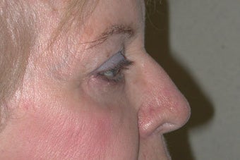 Upper and lower Blepharoplasty 410972