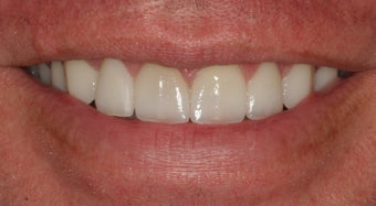 Porcelain Veneers after 213076