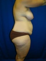 Breast Reduction, Tummy Tuck (Abdominoplasty), Mommy Makeover 404137
