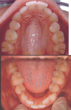 Invisalign before 109376